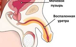 Воспаление ( уретрит ) мочевого канала у женщин