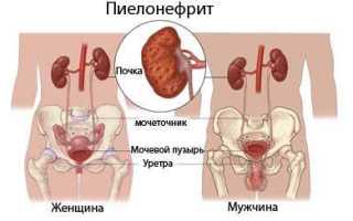 Факторы риска для развития хронического пиелонефрита