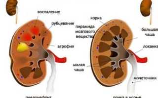 Урологический сбор при цистите: лечение, аптечные фитосборы