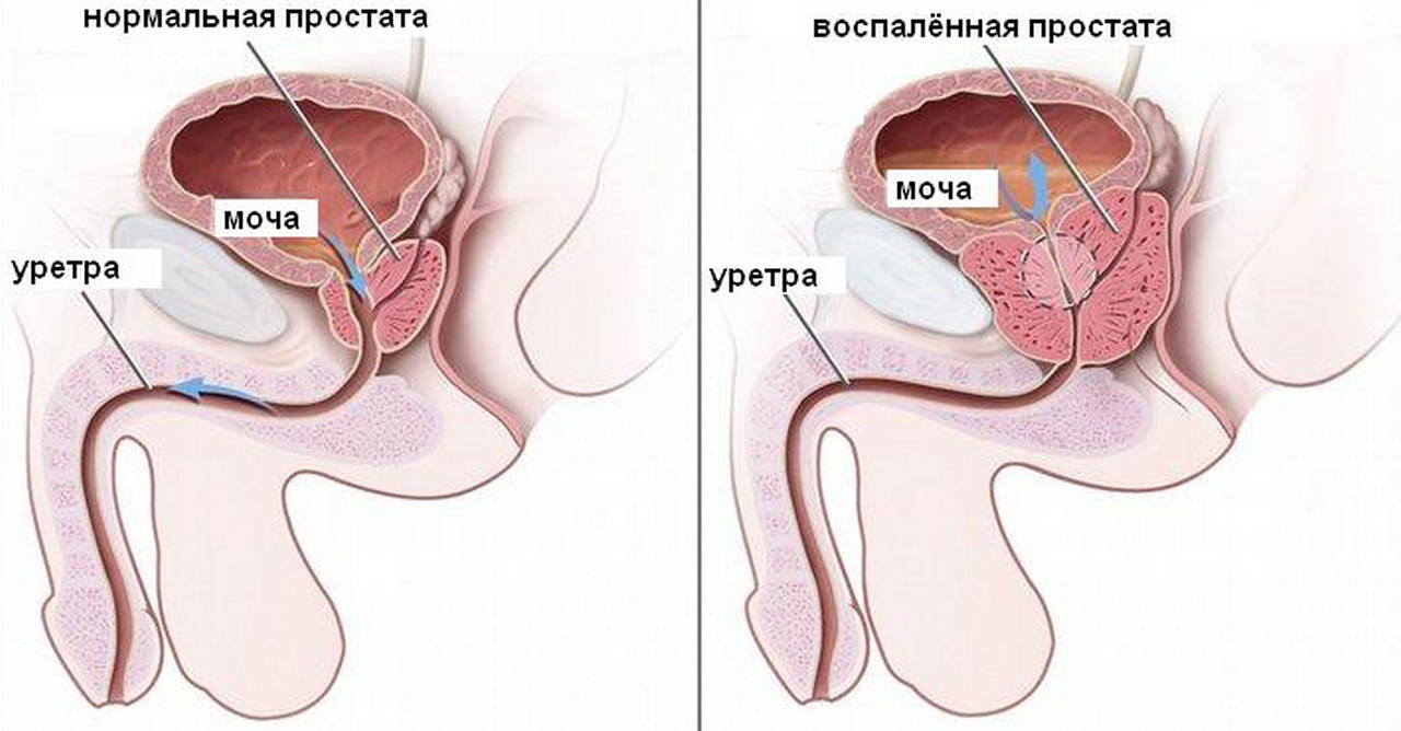 Простатит у мужчин: признаки и первые симптомы