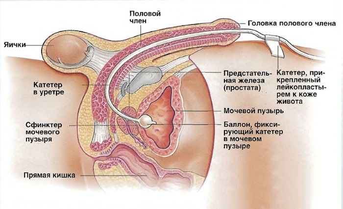 анестезирующий гель в урологии